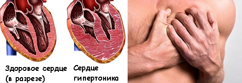 Поражение сердца в результате гипертонической болезни (высокое артериальное давление)