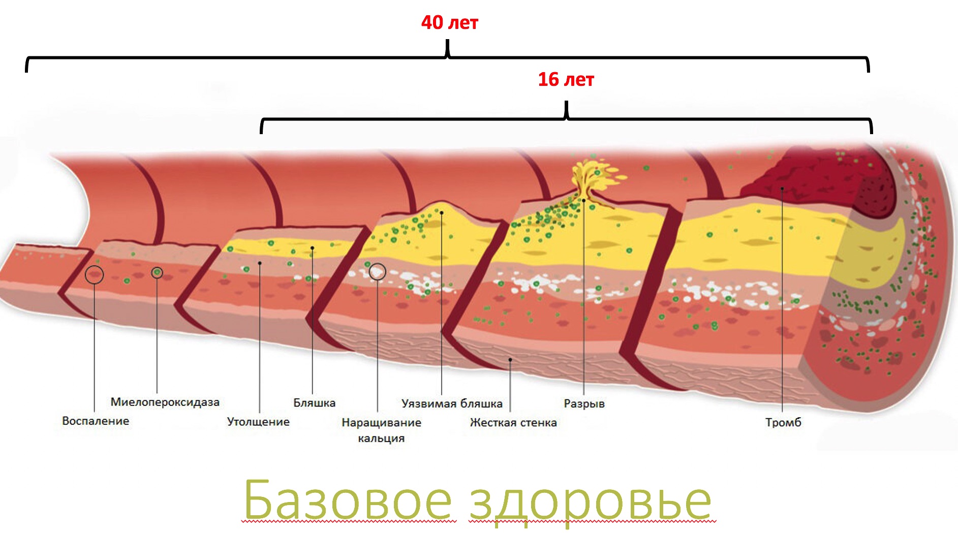 Тромб и бляшка разница. Ишемическая стадия атеросклероза. Атеросклероз коронарных артерий стадии и степени. Атеросклероз венечных артерий стадии и степень. Атеросклероз венечных артерий сердца.